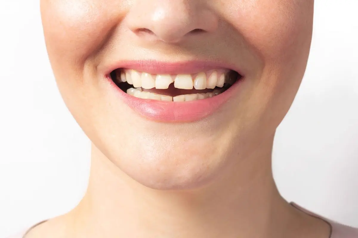 Tratamento para Dente Quebrado
