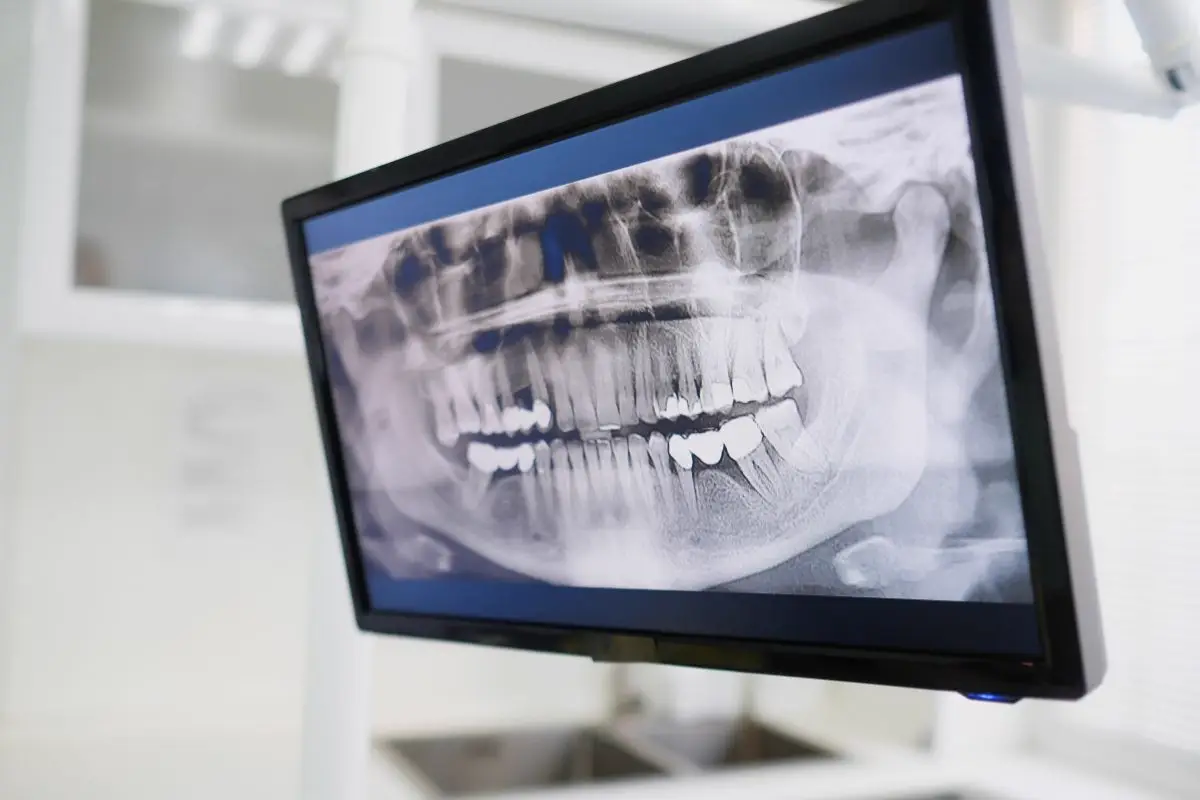 Raio-X Periapical Digital